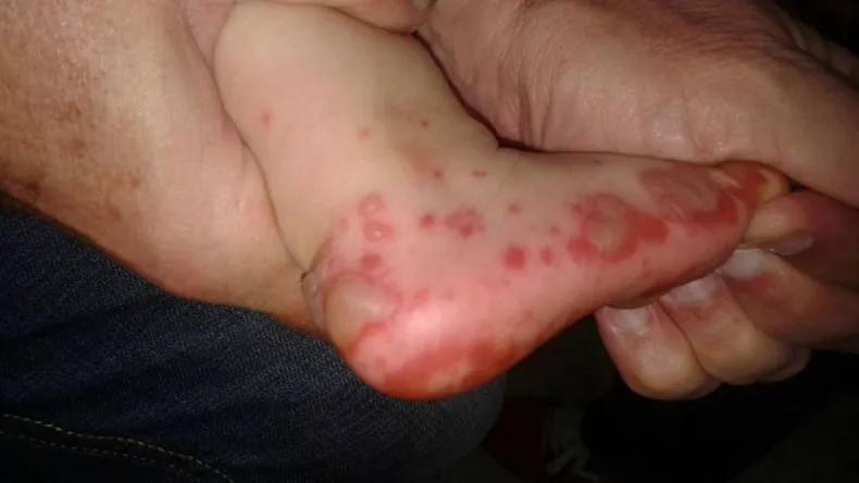 /que-es-la-enfermedad-boca-mano-pie-y-como-prevenir-su-contagio